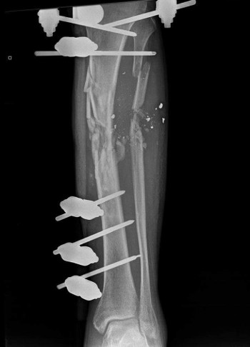 Radio de la jambe brisée de Yasser avec les broches utilisées pour ressouder les fragments